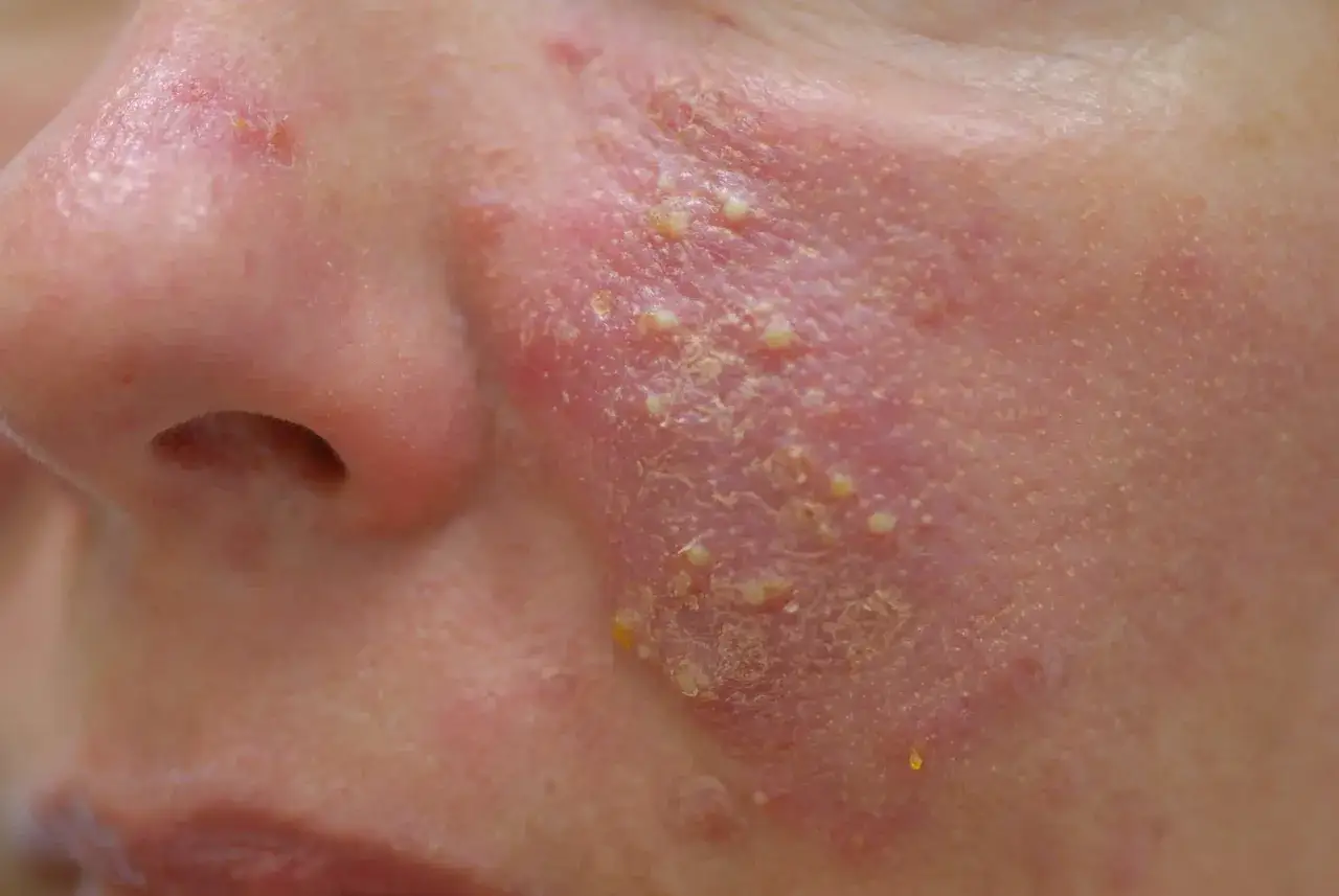 Rötungen im Gesicht: Was hilft wirklich gegen Couperose & Rosazea?