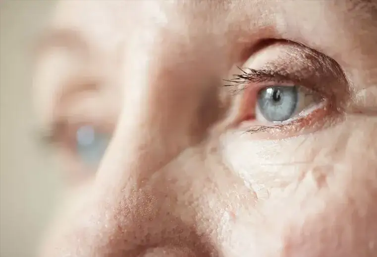 Zaćma wikłająca - co to jest, objawy, przyczyny i leczenie