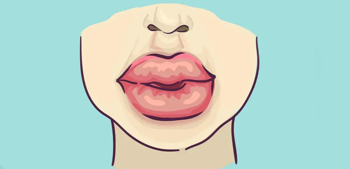 Jak rozpuścić kwas hialuronowy i uniknąć niepożądanych efektów