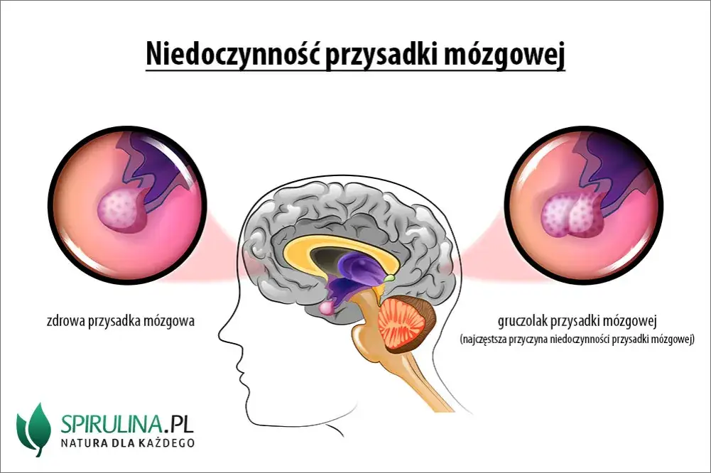 Mgła mózgowa, lęk, depresja? To może być gruczolak przysadki