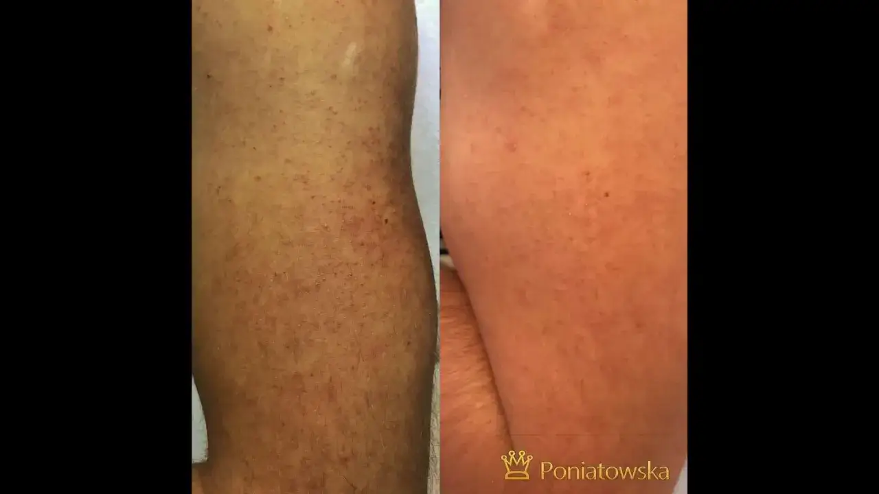 Mikrodermabrazja diamentowa: Odmłodź skórę! Jak to działa i co daje?