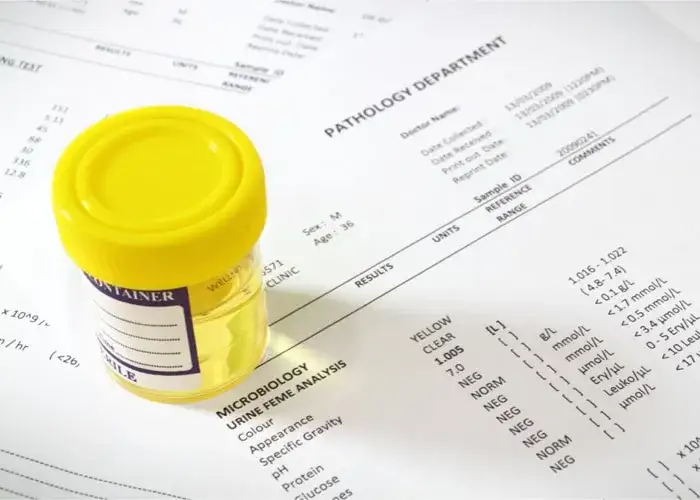 Co wykryje badanie moczu? Poznaj najważniejsze informacje o wynikach