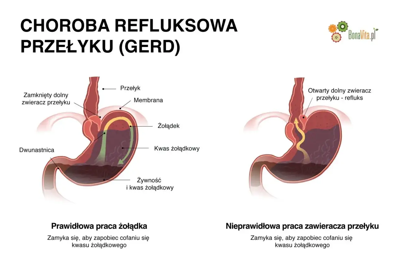 Objawy refluksu u dorosłych: Nie tylko zgaga! Kiedy iść do lekarza?
