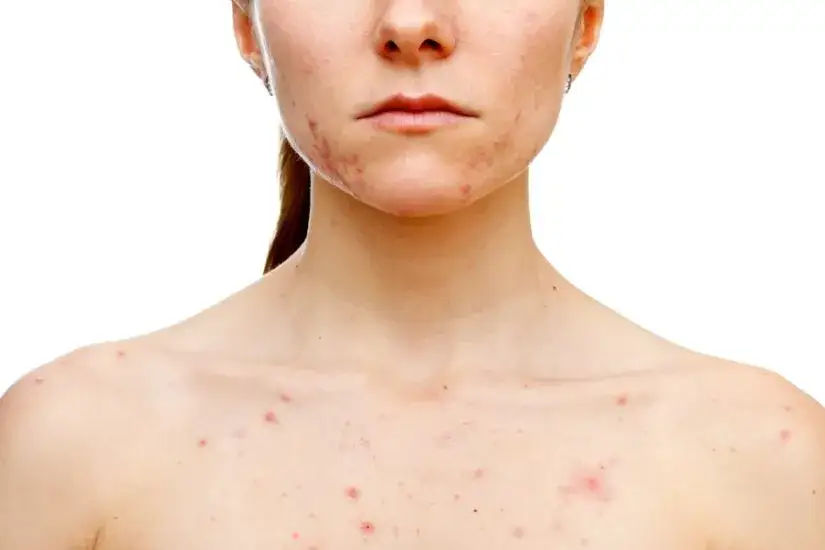 Skuteczne sposoby na pryszcze – co zrobić z pryszczami, aby zniknęły