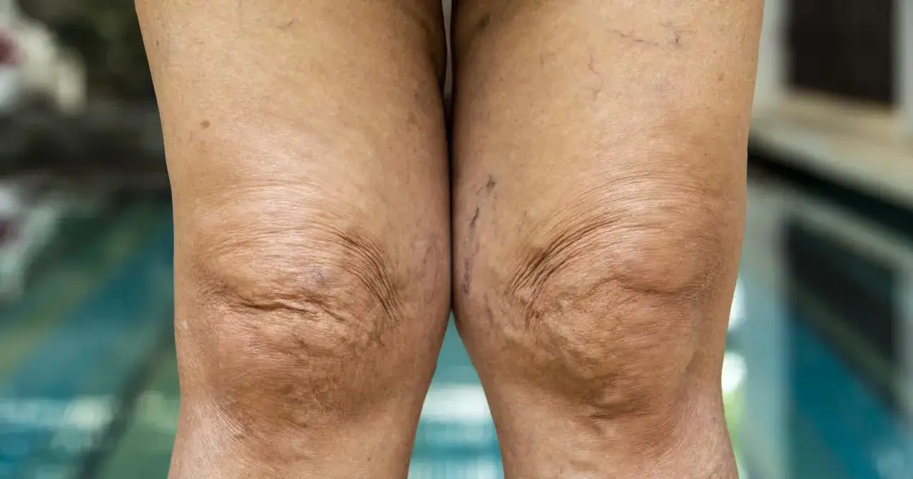 Czy to miażdżyca nóg? Poznaj objawy i chroń zdrowie!