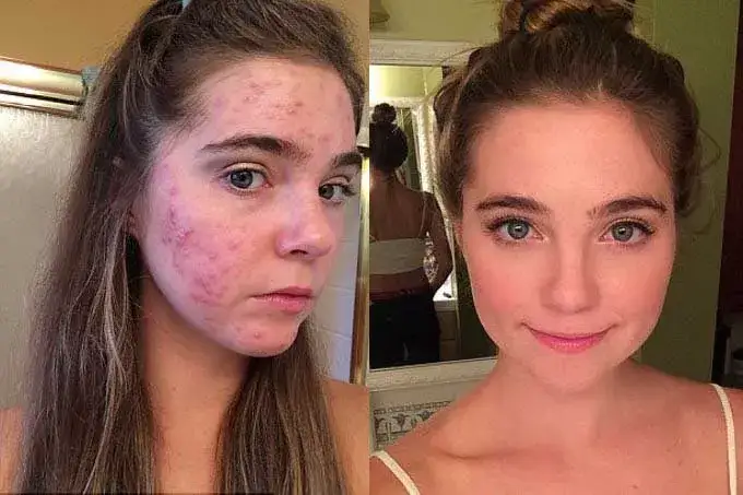 Czy pryszcz sam zniknie? Oto prawda o naturalnym gojeniu