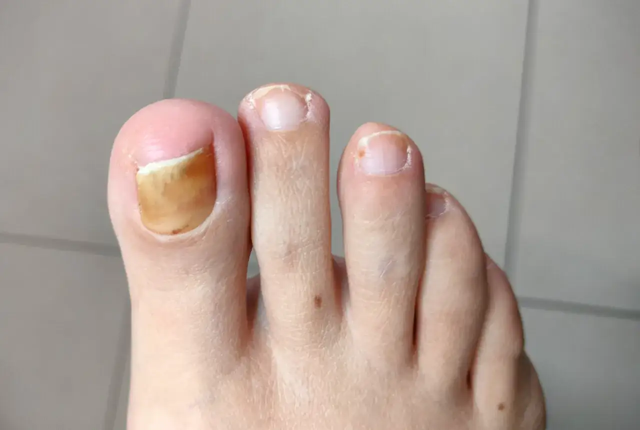 Grzybica stóp objawy: Jak rozpoznać i uniknąć poważnych problemów