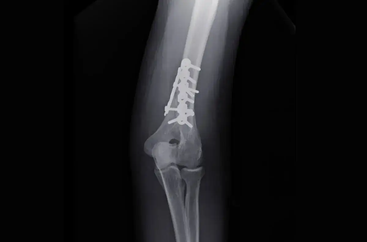 Kiedy zacząć rehabilitację po złamaniu kości ramiennej, aby uniknąć bólu?