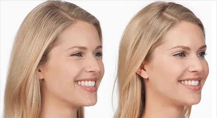 Czy po botoksie może boleć głowa? Oto co musisz wiedzieć