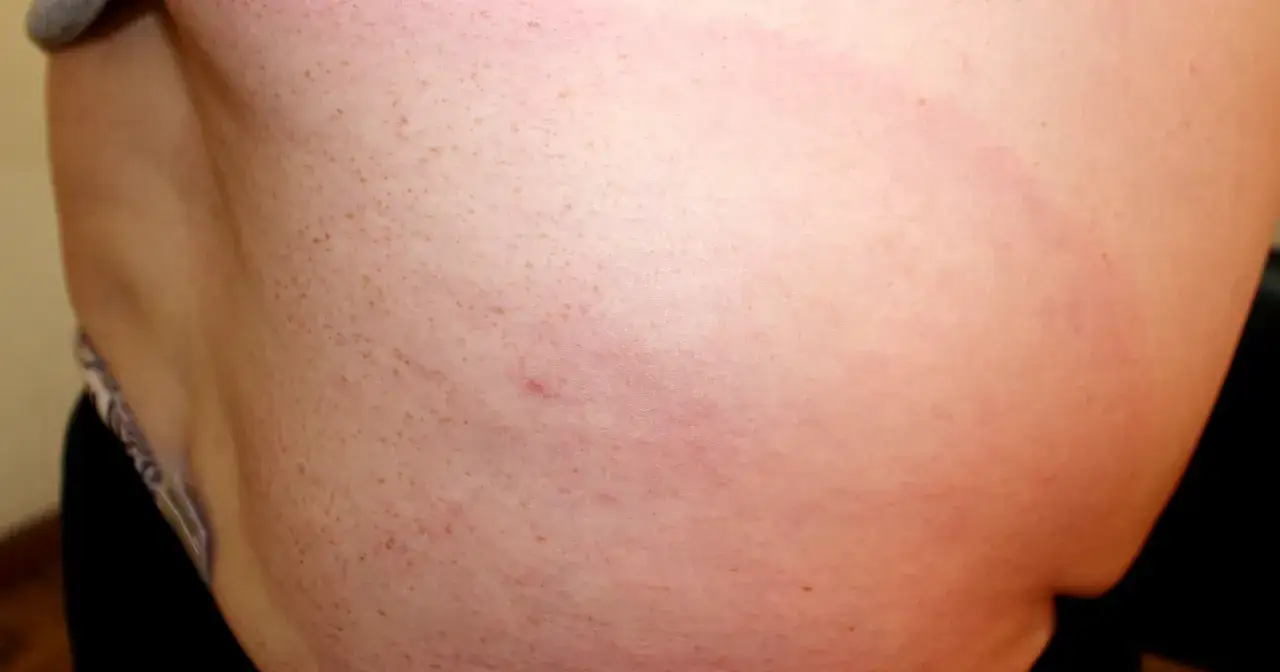 Obrzęk po kleszczu: Rumień wędrujący czy zwykła reakcja? Sprawdź!