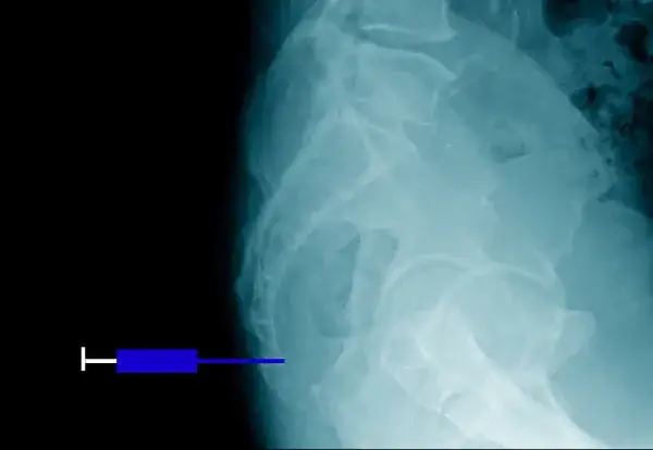 Jakie leki na ból kości ogonowej mogą naprawdę pomóc w ulgach?