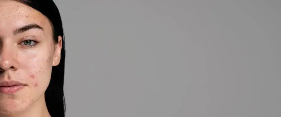 Kremy na niedoskonałości skóry – skuteczne rozwiązania na trądzik i pory