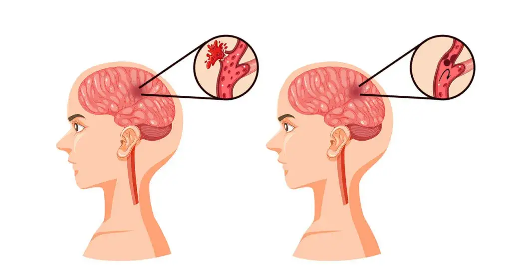 Dlaczego udar nazywa się zawałem mózgu? Wyjaśnienie i kluczowe różnice
