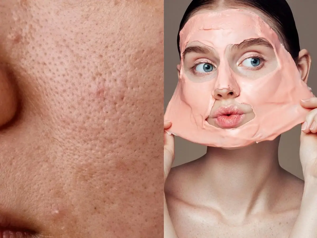 Jak wygląda zapchana cera i jak ją pielęgnować, by pozbyć się grudek?