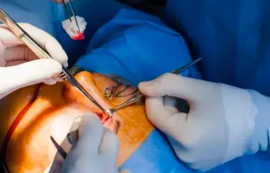 Czy korekcja powiek jest bezpieczna? Fakty i mity o zabiegu