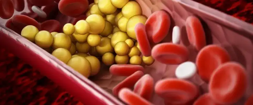 Podwyższony poziom trójglicerydów we krwi: skuteczne sposoby leczenia