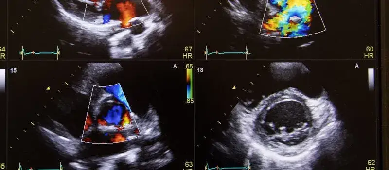 Jak odczytać wyniki badań Dopplera i zrozumieć ich znaczenie