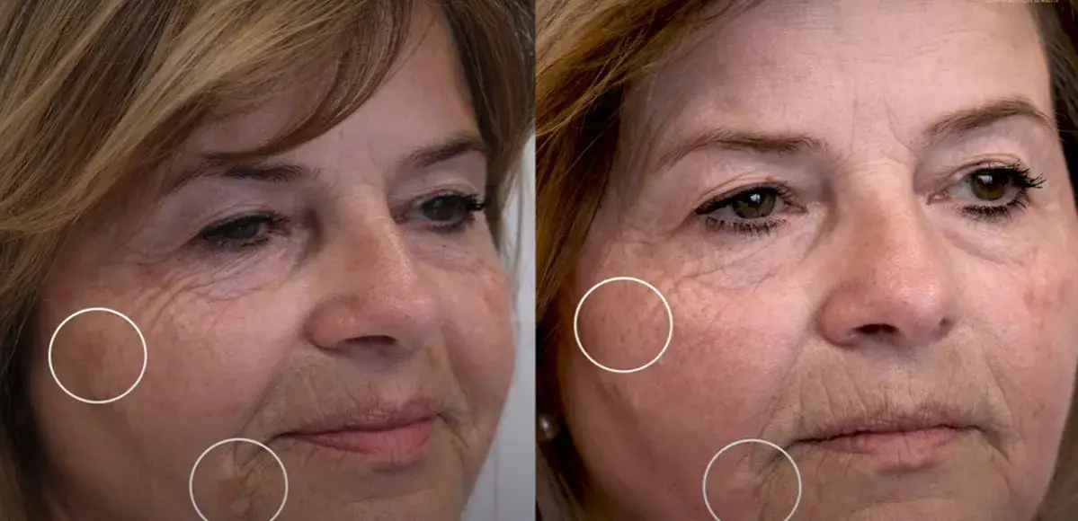 Laser frakcyjny po jakim czasie efekty – poznaj prawdę o rezultatach