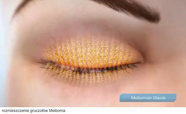 Zatkane gruczoły Meiboma objawy: jak je rozpoznać i leczyć?