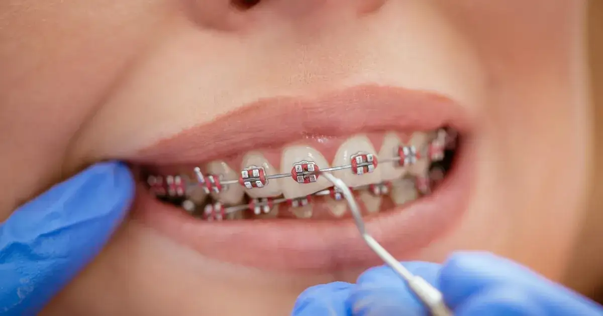 Kiedy trzeba nosić aparat na zęby? Odkryj kluczowe informacje dla rodziców