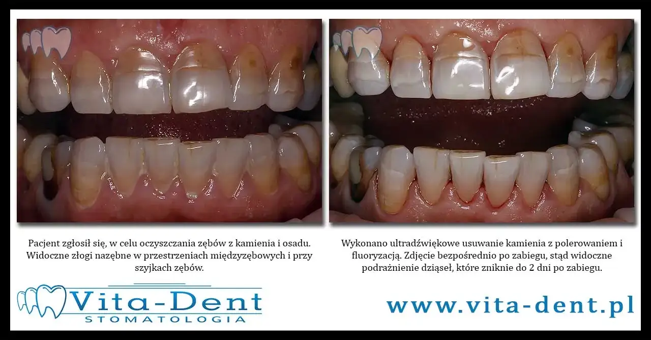 Dowiedz się co ile czasu można usuwać kamień nazębny: zalecenia ekspertów