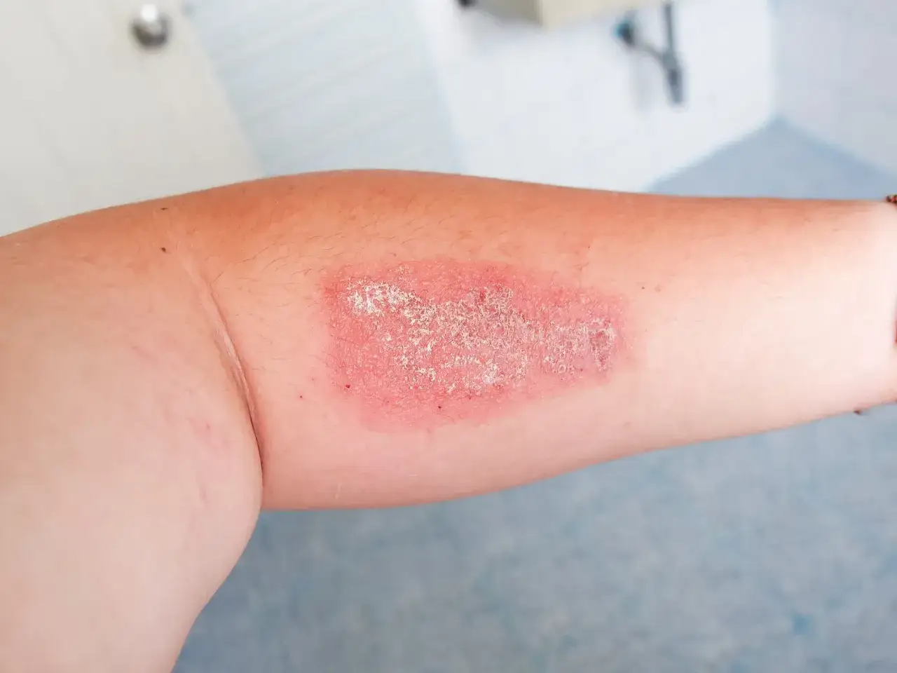 Czy gronkowiec jest zakaźny? Poznaj objawy i drogi zakażenia - poradnik