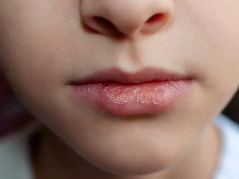 Co oznacza suchość w jamie ustnej? Przyczyny i skutki, które warto znać