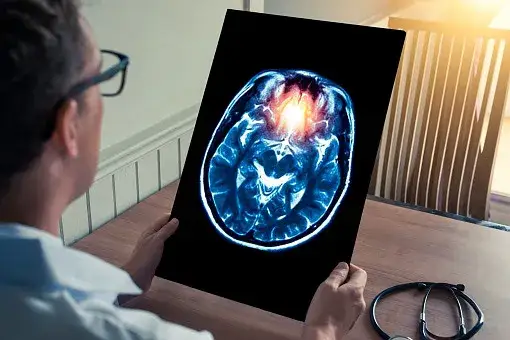 Jak zapobiec udarowi: 10 skutecznych sposobów na ochronę zdrowia