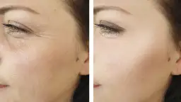 Comparación antes y después de radiofrecuencia facial: piel con arrugas profundas y piel visiblemente más lisa y rejuvenecida.