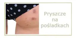 Jak szybko wysuszyć pryszcza? Skuteczne metody i czego unikać