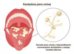 Kandydoza jamy ustnej to choroba spowodowana nieprawidłowym rozrostem drożdżaków z rodzaju Candida albicans, widoczna jako białe naloty na języku i w jamie ustnej.