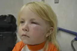 Silne uczulenie na komary u dziecka. Powieka jest mocno opuchnięta, zaczerwieniona, z widocznymi śladami ukąszeń na policzku.