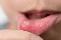 Objawy HPV w jamie ustnej - co możesz przegapić i jak reagować