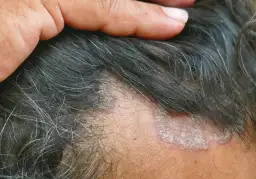 Schuppen im Haar: Ursachen, Behandlung & Hausmittel für gesunde Kopfhaut