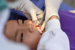 Krwawienie po wyrwaniu zęba jak długo trwa i kiedy jest niebezpieczne