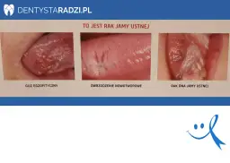 Rak jamy ustnej: wczesne objawy, które musisz znać (do 70 znaków)