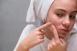 Pryszcze: Szybka pomoc, skuteczna pielęgnacja i zapobieganie