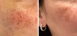 Jak długo goi się skóra po laserze frakcyjnym? Czas regeneracji