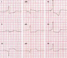 Objawy zaburzeń repolaryzacji EKG: Kiedy się martwić, a kiedy nie?