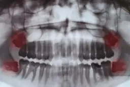 Kiedy rosną zęby mądrości? Objawy, ból i kiedy iść do dentysty