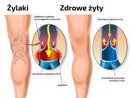 Ilustracja porównująca żylaki z zdrowymi żyłami, pokazująca nieprawidłowe działanie zastawek żylnych.