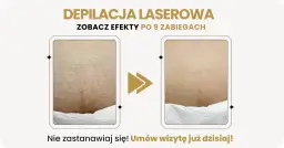Porównanie skóry przed i po depilacji laserowej bikini.