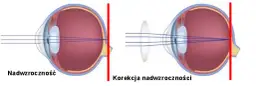Maksymalna wada wzroku: co musisz wiedzieć o dioptriach i ich skutkach