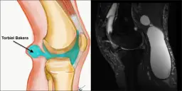 Zgrubienie pod kolanem, czyli torbiel Bakera, widoczne na rysunku anatomicznym i obrazie rezonansu magnetycznego.