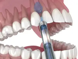 Jak długo działa znieczulenie u dentysty? Sprawdź, kiedy wróci czucie!