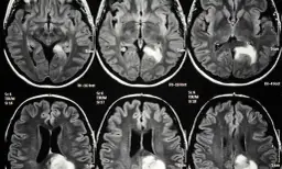 Czy rezonans magnetyczny wykryje chorobę psychiczną? Oto prawda