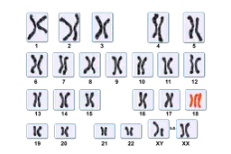 Kariotyp przedstawia pary chromosomów, w tym jedną parę w kolorze pomarańczowym, sugerującą anomalię.