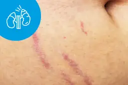 Rozstępy na skórze, które mogą być objawem zespołu Cushinga. Widoczny symbol nerek.