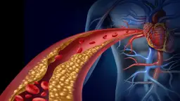 Zaburzenia lipidowe (dyslipidemia) to stan, gdy we krwi jest za dużo złego cholesterolu, co prowadzi do zwężenia naczyń krwionośnych i problemów z sercem.