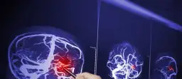 Jak odróżnić nerwicę od guza mózgu - objawy, które musisz znać